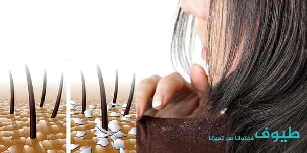 علاج قشرة الرأس علاج قشرة الرأس
