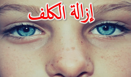 التخلص من كلف الحمل التخلص من كلف الحمل
