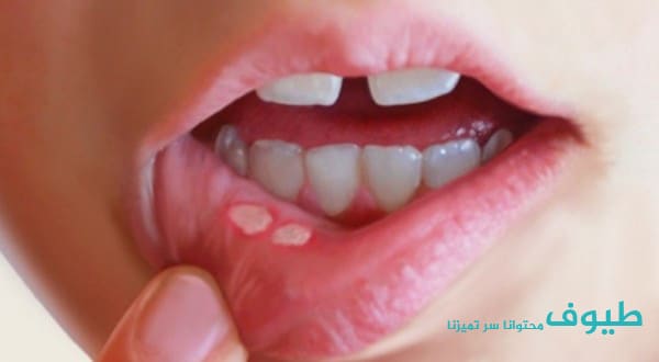 علاج تقرحات الفم علاج تقرحات الفم