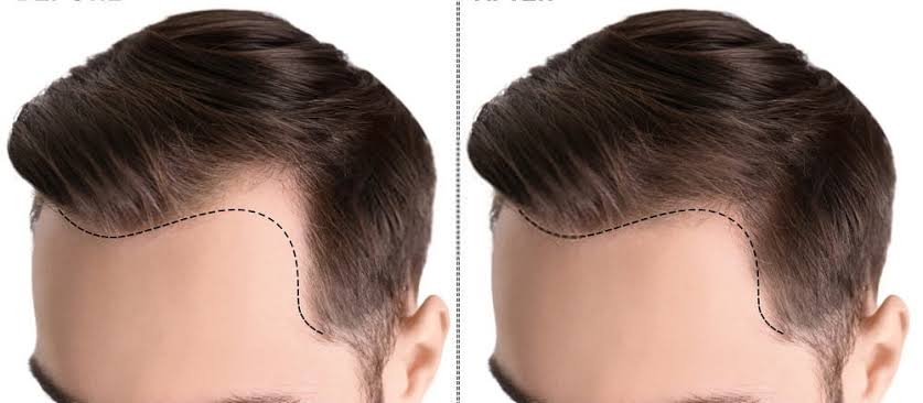 تكلفة زراعة الشعر في تركيا