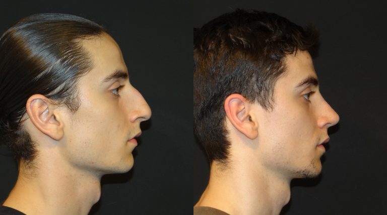 اسعار عمليه تجميل الانف عند الدكتور عبدالكريم فدا بجدة اسعار عمليه تجميل الانف عند الدكتور عبدالكريم فدا