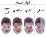شكل انواع الصداع
