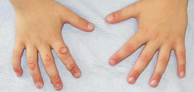 علاج السنط علاج السنط