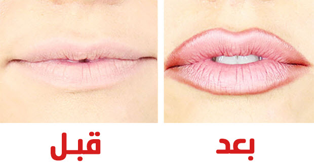 فيلر الشفايف الطبيعي بالصور