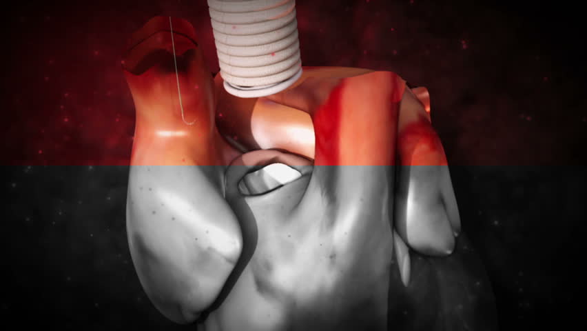 هل عملية تغيير صمام القلب خطيرة أم لا هل عملية تغيير صمام القلب خطيرة